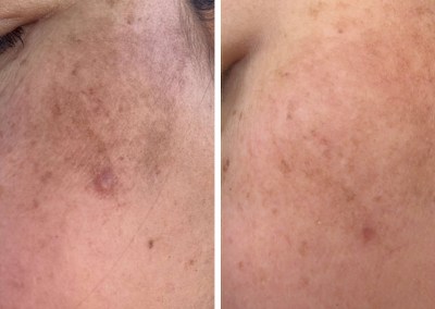 Microneedling with Brightening Exosomes